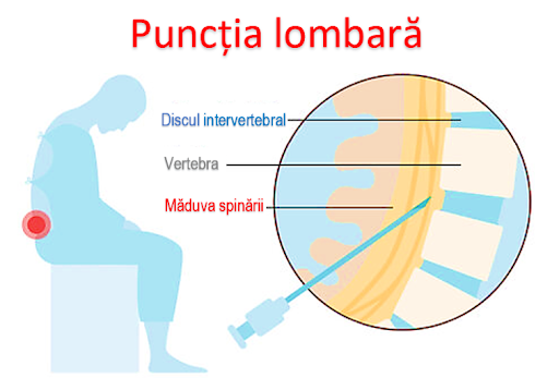Ilustratia 1 exemplu de pozitie in timpul interventiei punctiei lombare