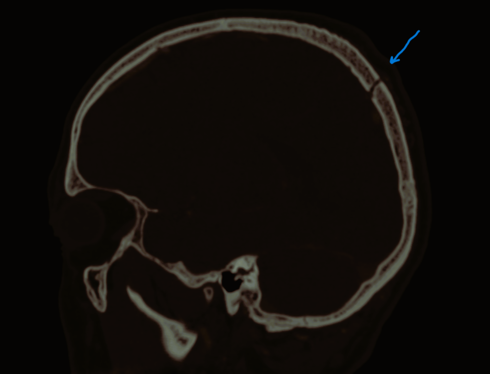 gaura parietala folosita pentru a patrunde in craniu pentru a evita chirurgia descisa a creierului