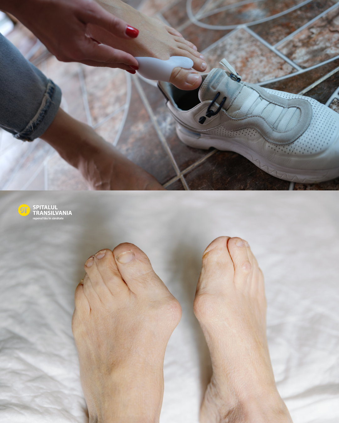 Operația pentru monturi (hallux valgus) – ce presupune și când este recomandată 2 Exemplu de Monturi - Hallux valgus