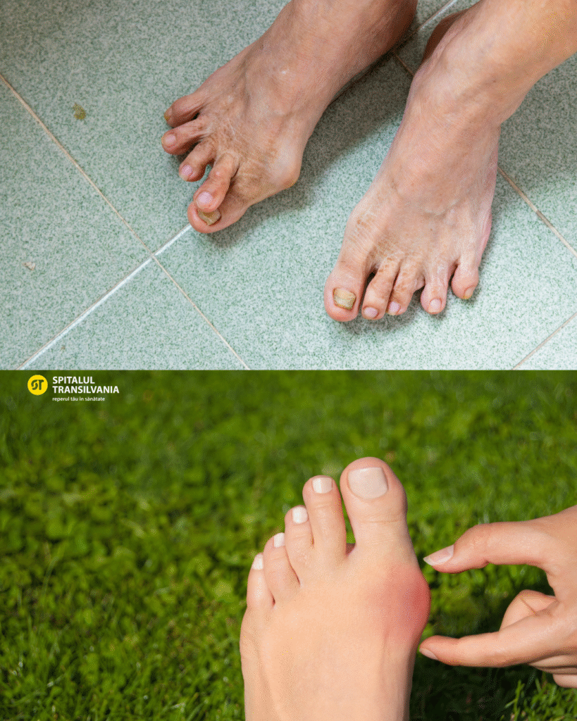 Monturi (hallux valgus) 7 Cazuri Postari 2025 17