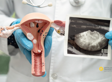 sindromul ovarelor polichistice menstruație neregulată infertilitate feminin ovare polichistice tratament SOPC