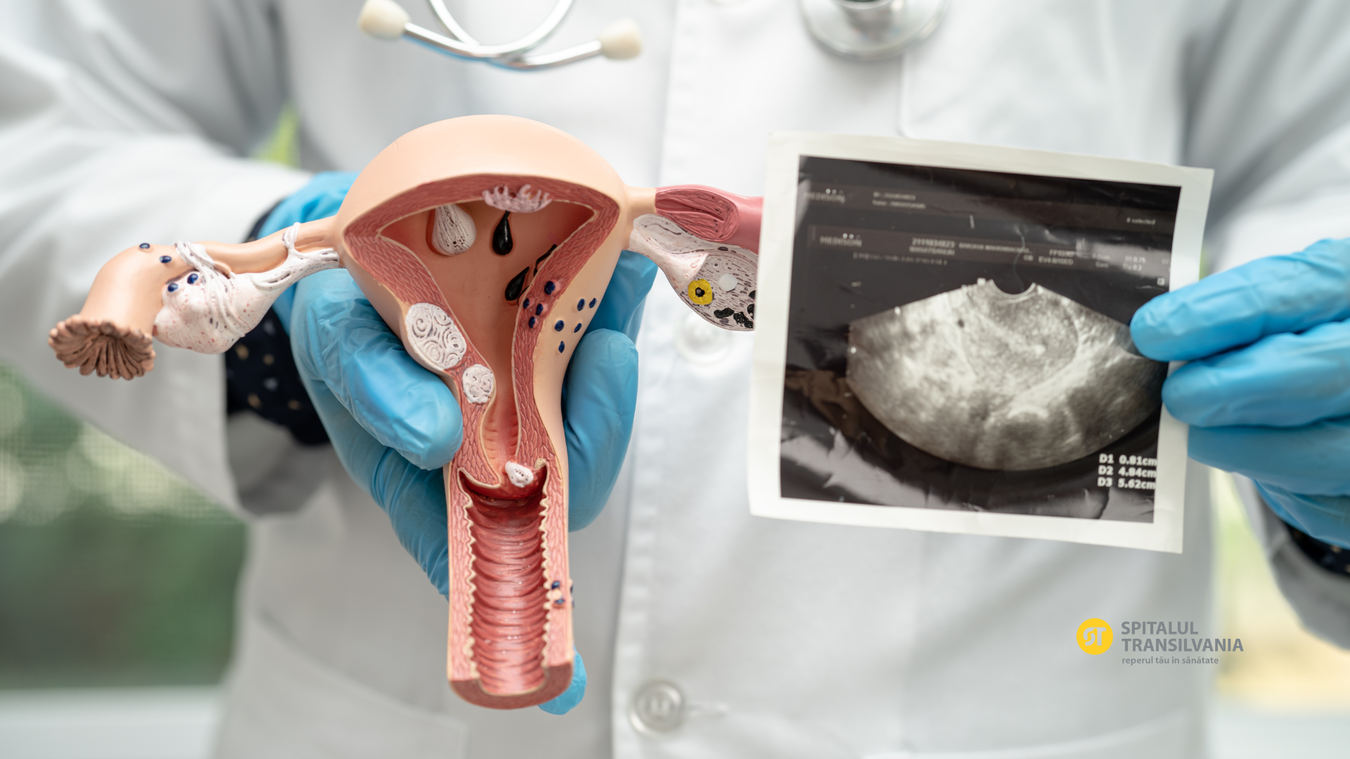 Sindromul Ovarelor Polichistice (SOPC) 1 sindromul ovarelor polichistice menstruație neregulată infertilitate feminin ovare polichistice tratament SOPC