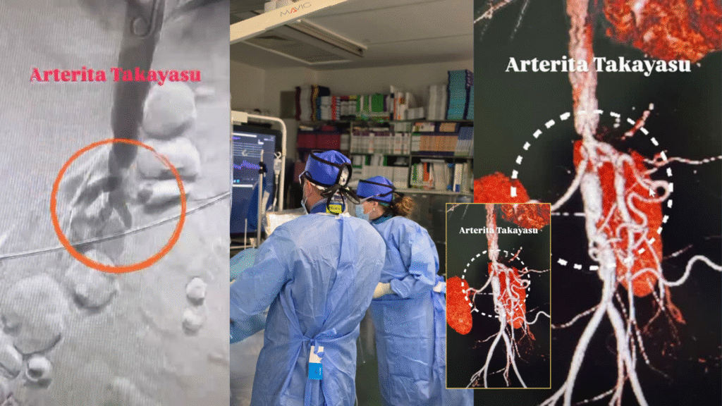 Tehnica Chimney Graft | Medicină de ultimă generație la Spitalul Transilvania: reconstrucția minim invazivă a aortei și a ramurilor abdominale 2 tv 16